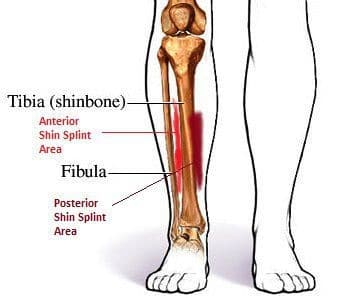 Shin splints, shin pain, medial tibial stress syndrome. Ouch.