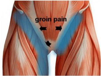 WHAT IS MY GROIN PAIN?